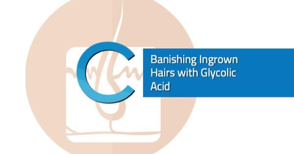 Glycolic Acid Ingrown Hairs