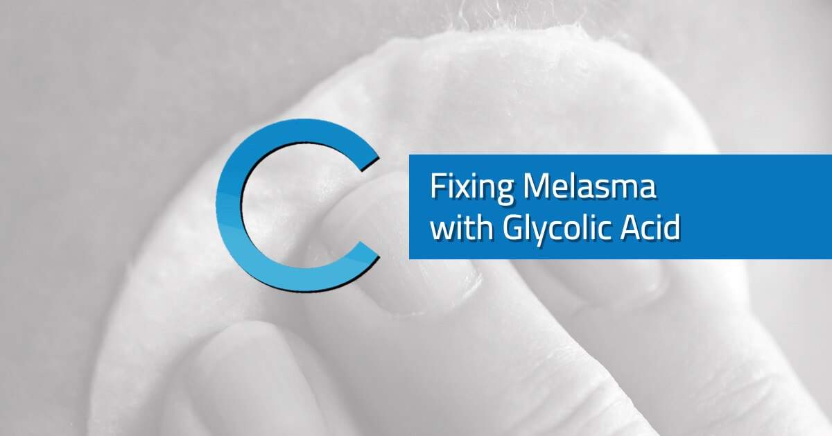 Fixing Melasma with Glycolic Acid