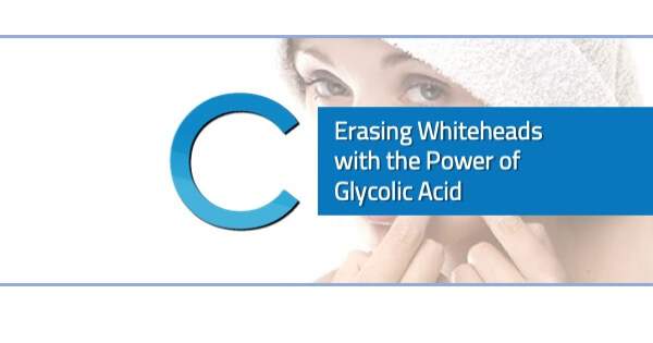 Erasing Whiteheads Glycolic Acid